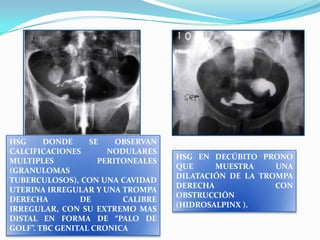 HSG
DONDE
SE
OBSERVAN
CALCIFICACIONES
NODULARES
MULTIPLES
PERITONEALES
(GRANULOMAS
TUBERCULOSOS), CON UNA CAVIDAD
UTERINA IRREGULAR Y UNA TROMPA
DERECHA
DE
CALIBRE
IRREGULAR, CON SU EXTREMO MAS
DISTAL EN FORMA DE “PALO DE
GOLF”. TBC GENITAL CRONICA

HSG EN DECÚBITO PRONO
QUE
MUESTRA
UNA
DILATACIÓN DE LA TROMPA
DERECHA
CON
OBSTRUCCIÓN
(HIDROSALPINX ).

 