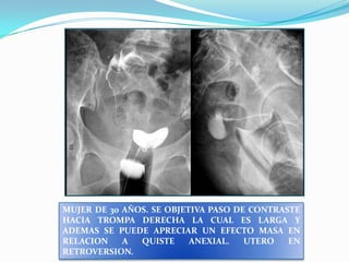 MUJER DE 30 AÑOS. SE OBJETIVA PASO DE CONTRASTE
HACIA TROMPA DERECHA LA CUAL ES LARGA Y
ADEMAS SE PUEDE APRECIAR UN EFECTO MASA EN
RELACION
A
QUISTE
ANEXIAL.
UTERO
EN
RETROVERSION.

 