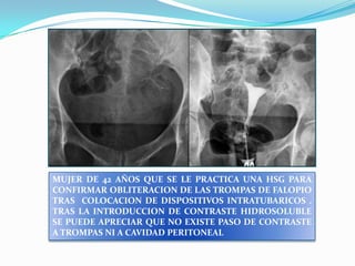 MUJER DE 42 AÑOS QUE SE LE PRACTICA UNA HSG PARA
CONFIRMAR OBLITERACION DE LAS TROMPAS DE FALOPIO
TRAS COLOCACION DE DISPOSITIVOS INTRATUBARICOS .
TRAS LA INTRODUCCION DE CONTRASTE HIDROSOLUBLE
SE PUEDE APRECIAR QUE NO EXISTE PASO DE CONTRASTE
A TROMPAS NI A CAVIDAD PERITONEAL

 