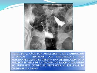 MUJER DE 32 AÑOS CON ANTECEDENTE DE 2 EMBARAZOS
ECTOPICOS
TRATADOS CON METOTREXATE. TRAS
PRACTICARLE LA HSG SE OBSERVA UNA OBSTRUCCION EN LA
PORCION ISTMICA DE LA TROMPA DE FALOPIO IZQUIERDA
NO PUDIENDO CONSEGUIR DISTENDER NI RELLENAR DE
CONTRASTE LA MISMA

 