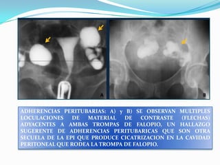 ADHERENCIAS PERITUBARIAS: A) y B) SE OBSERVAN MULTIPLES
LOCULACIONES
DE
MATERIAL
DE
CONTRASTE
(FLECHAS)
ADYACENTES A AMBAS TROMPAS DE FALOPIO, UN HALLAZGO
SUGERENTE DE ADHERENCIAS PERITUBARICAS QUE SON OTRA
SECUELA DE LA EPI QUE PRODUCE CICATRIZACION EN LA CAVIDAD
PERITONEAL QUE RODEA LA TROMPA DE FALOPIO.

 