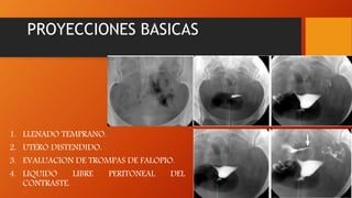 PROYECCIONES BASICAS
1. LLENADO TEMPRANO.
2. UTERO DISTENDIDO.
3. EVALUACION DE TROMPAS DE FALOPIO.
4. LIQUIDO LIBRE PERITONEAL DEL
CONTRASTE.
 