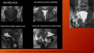 N. Sanchez Rubio A. et al. Histerosalpingografia: Tecnica, hallazgos e indicaciones actuales. SERAM.. Octubre 2012. Vol Pag 1-31.
 