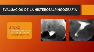 EVALUACION DE LA HISTEROSALPINGOGRAFIA
UTERO
 ANOMALIAS CONGENITAS
 DEFECTOS DE LLENADO.
 CONTORNO DEL UTERO
 