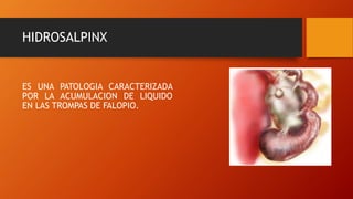 HIDROSALPINX
ES UNA PATOLOGIA CARACTERIZADA
POR LA ACUMULACION DE LIQUIDO
EN LAS TROMPAS DE FALOPIO.
 