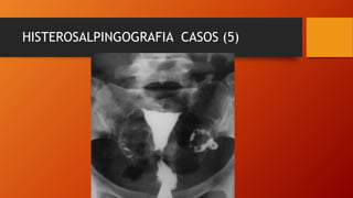 HISTEROSALPINGOGRAFIA CASOS (5)
 