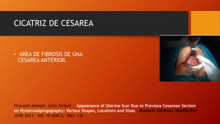 CICATRIZ DE CESAREA
• AREA DE FIBROSIS DE UNA
CESAREA ANTERIOR.
Firoozeh Ahmadi. Leila Torbati. Appearance of Uterine Scar Due to Previous Cesarean Section
on Hysterosalpingography: Various Shapes, Locations and Sizes . IRANIAN JOURNAL RADIOLOGY.
JUNE 2013. VOL 10 NUM 2. PAG: 1-8.
 