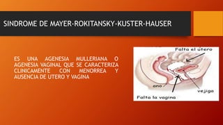 SINDROME DE MAYER-ROKITANSKY-KUSTER-HAUSER
ES UNA AGENESIA MULLERIANA O
AGENESIA VAGINAL QUE SE CARACTERIZA
CLINICAMENTE CON MENORREA Y
AUSENCIA DE UTERO Y VAGINA
 
