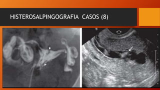 HISTEROSALPINGOGRAFIA CASOS (8)
 