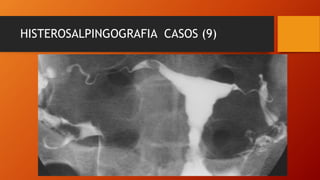 HISTEROSALPINGOGRAFIA CASOS (9)
 