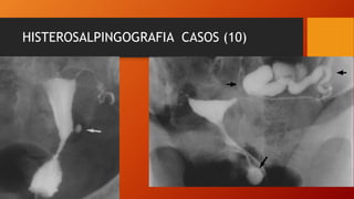 HISTEROSALPINGOGRAFIA CASOS (10)
 