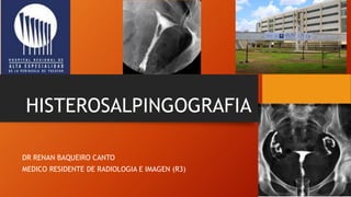 HISTEROSALPINGOGRAFIA
DR RENAN BAQUEIRO CANTO
MEDICO RESIDENTE DE RADIOLOGIA E IMAGEN (R3)
 
