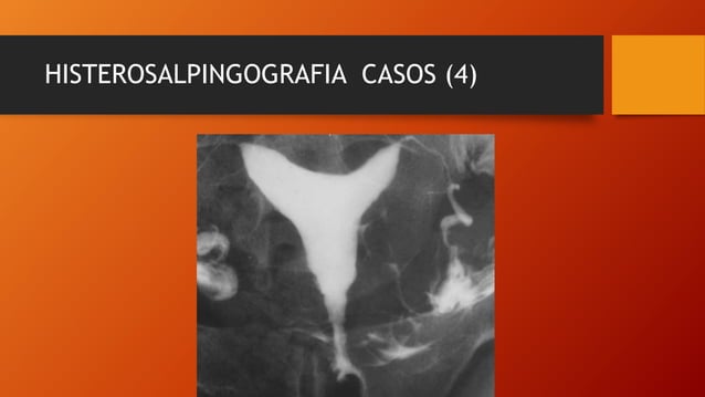 Histerosalpingografia