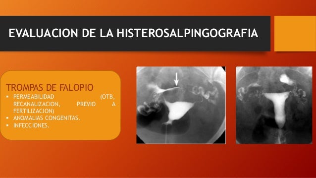 Histerosalpingografia