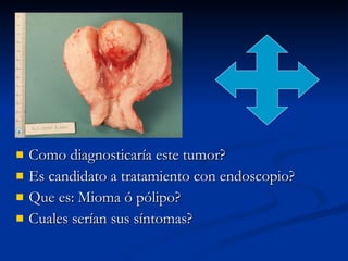 Como diagnosticaría este tumor? Es candidato a tratamiento con endoscopio? Que es: Mioma ó pólipo? Cuales serían sus síntomas? 
