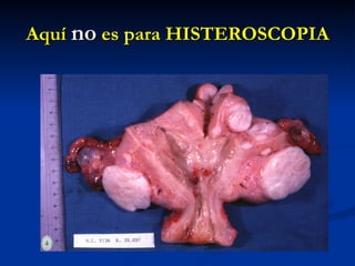 Aquí  no  es para HISTEROSCOPIA 