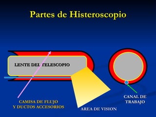 Partes de Histeroscopio LENTE DEL TELESCOPIO CAMISA DE FLUJO Y DUCTOS ACCESORIOS AREA DE VISION CANAL DE TRABAJO 