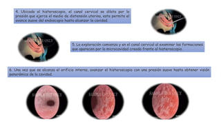 4. Ubicado el histeroscopio, el canal cervical se dilata por la
presión que ejerce el medio de distensión uterina, esto permite el
avance suave del endoscopio hasta alcanzar la cavidad.
5. La exploración comienza y en el canal cervical al examinar las formaciones
que aparecen por la microcavidad creada frente al histeroscopio.
6. Una vez que se alcanza el orificio interno, avanzar el histeroscopio con una presión suave hasta obtener visión
panorámica de la cavidad.
 