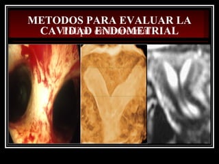 Pólipo endometrial
METODOS PARA EVALUAR LA
CAVIDAD ENDOMETRIAL
 