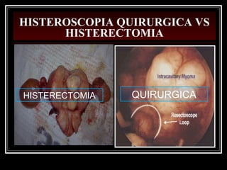 HISTEROSCOPIA QUIRURGICA VS
HISTERECTOMIA
QUIRURGICAHISTERECTOMIA
 