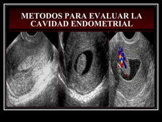 METODOS PARA EVALUAR LA
CAVIDAD ENDOMETRIAL
 