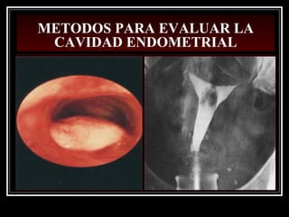 METODOS PARA EVALUAR LA
CAVIDAD ENDOMETRIAL
 