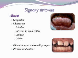 Boca 
Gingivitis 
Ulceras en: 
Paladar 
Interior de las mejillas 
Lengua 
Labios 
Dientes que se vuelven disparejos. 
Pérdida de dientes. 
 