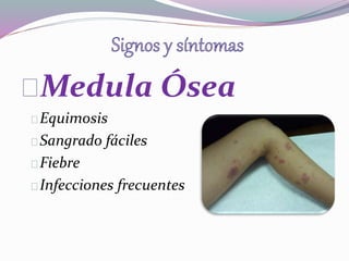 Medula Ósea 
Equimosis 
Sangrado fáciles 
Fiebre 
Infecciones frecuentes 
 