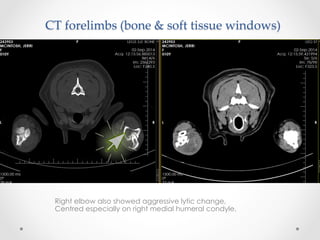 Right elbow also showed aggressive lytic change,
Centred especially on right medial humeral condyle.
CT  forelimbs  (bone  &  soft  tissue  windows)	
 