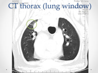 CT  thorax  (lung  window)	
 