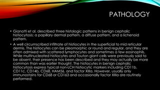 lecture on Histiocytoses with its types.pptx