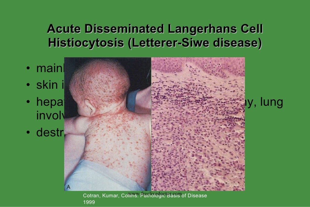 Histiocytosis Histiocytosis