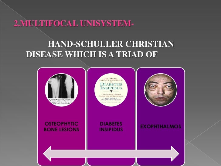 Histiocytosis x by dr kartik sood