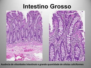 Intestino Grosso Ausência de vilosidades intestinais e grande quantidade de células caliciformes