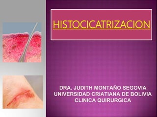 HISTOCICATRIZACION
DRA. JUDITH MONTAÑO SEGOVIA
UNIVERSIDAD CRIATIANA DE BOLIVIA
CLINICA QUIRURGICA
 