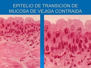 EPITELIO DE TRANSICION DE
MUCOSA DE VEJIGA CONTRAIDA
 