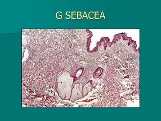 G SEBACEA
 