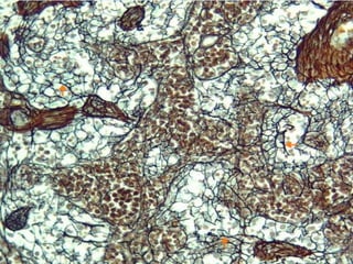 FIBRAS RETICULARES GANGLIO
LINFATICO
 