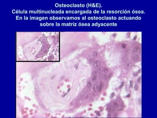 Osteoclasto (H&E).
Célula multinucleada encargada de la resorción ósea.
En la imagen observamos al osteoclasto actuando
sobre la matriz ósea adyacente
 