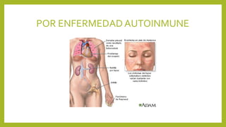 POR ENFERMEDADAUTOINMUNE
 