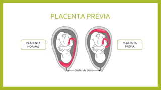 PLACENTA PREVIA
PLACENTA
NORMAL
PLACENTA
PREVIA
 