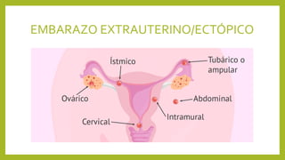 EMBARAZO EXTRAUTERINO/ECTÓPICO
 