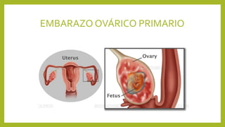 EMBARAZO OVÁRICO PRIMARIO
 