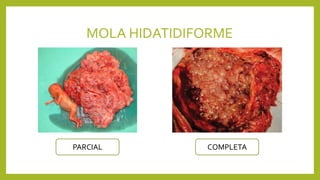 MOLA HIDATIDIFORME
PARCIAL COMPLETA
 