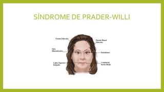 SÍNDROME DE PRADER-WILLI
 
