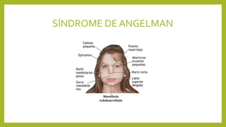 SÍNDROME DE ANGELMAN
Mandíbula
subdesarrollada
 