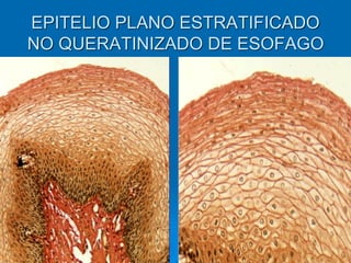 EPITELIO PLANO ESTRATIFICADO
NO QUERATINIZADO DE ESOFAGO
 