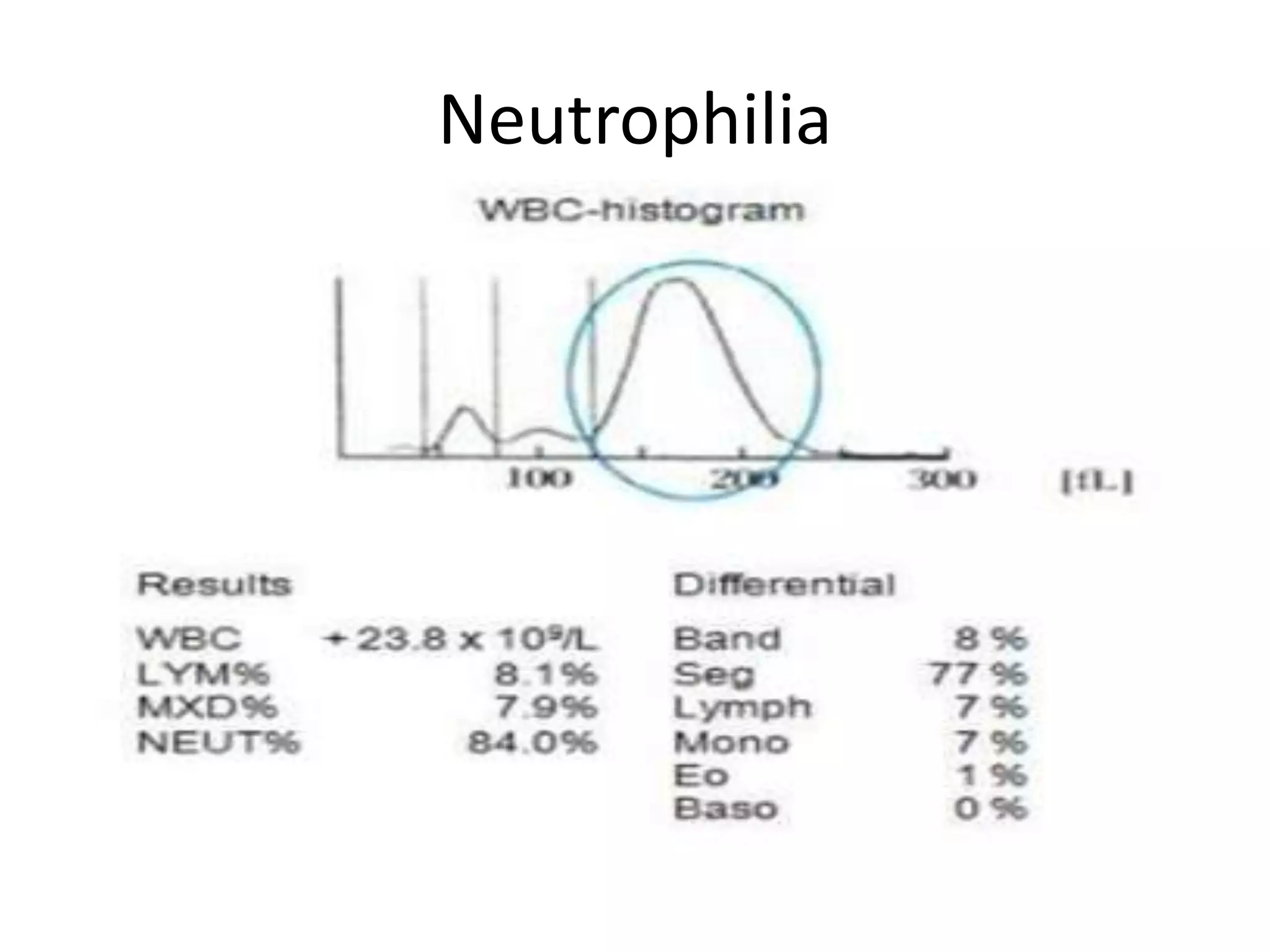Neutrophilia
 