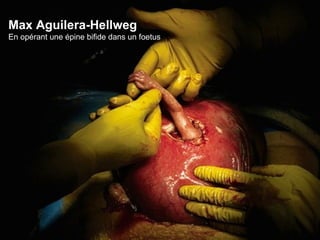 Max Aguilera-Hellweg En opérant une épine bifide dans un foetus 