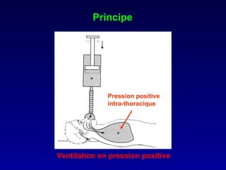 Principe Ventilation en pression positive Pression positive intra-thoracique 